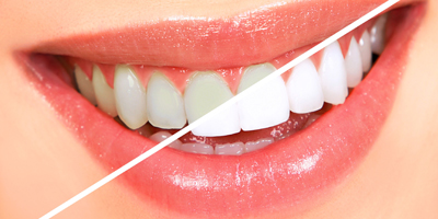 Tooth Whitening (Bleaching)