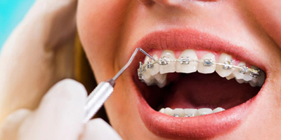 Braces Treatment