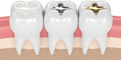 All Type Tooth Filling